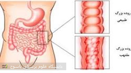 بیماری-های-التهابی-روده-اختلالات-مزمن-روده-هستند-و-عمدتا-به-دو-بیماری-کرون-و-کولیت-اولسراتیو-اشاره-دارد