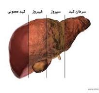 تغذیه صحیح در کبد چرب 